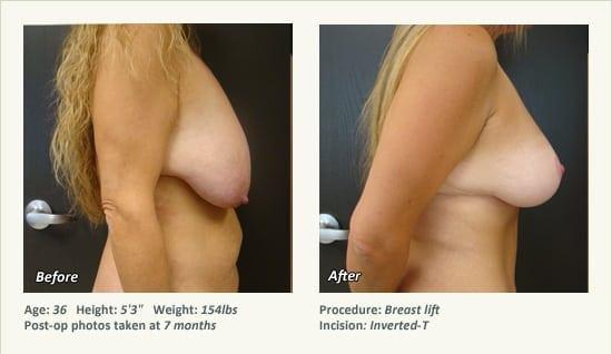 Breast Lift result at West Plano Plastic Surgery Center in Plano, TX