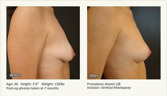 Breast Lift result at West Plano Plastic Surgery Center in Plano, TX