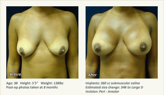 West Plano Plastic Surgery Center result — Plano, TX