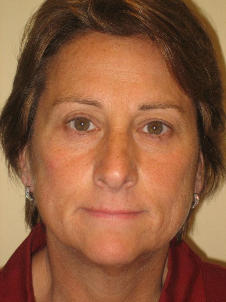 Arnold S. Breitbart, MD rhinoplasty after — Manhasset, NY
