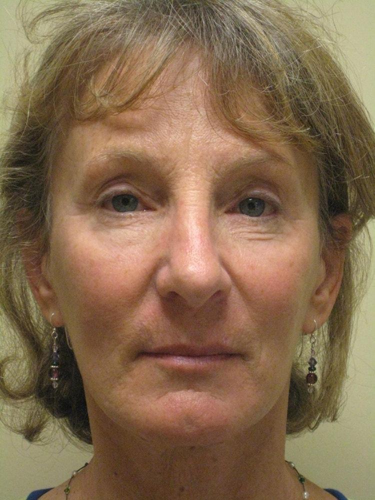 Arnold S. Breitbart, MD rhinoplasty after — Manhasset, NY