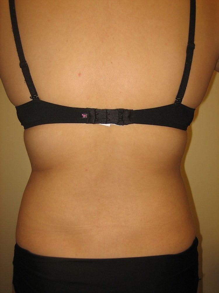 Arnold S. Breitbart, MD liposuction after — Manhasset, NY