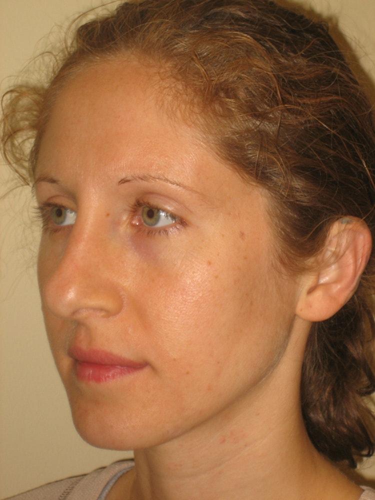 Arnold S. Breitbart, MD rhinoplasty after — Manhasset, NY