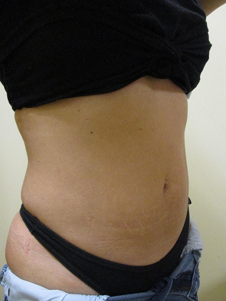 Arnold S. Breitbart, MD liposuction after — Manhasset, NY