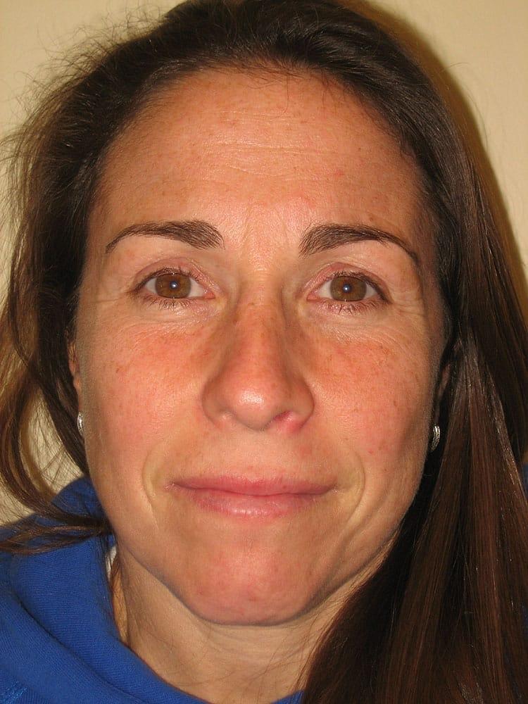 Arnold S. Breitbart, MD rhinoplasty after — Manhasset, NY