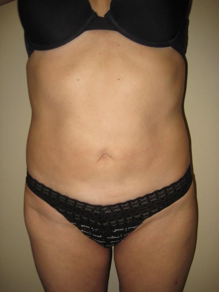 Arnold S. Breitbart, MD liposuction after — Manhasset, NY