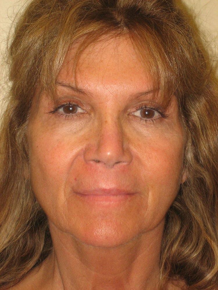 Arnold S. Breitbart, MD laser treatment after — Manhasset, NY