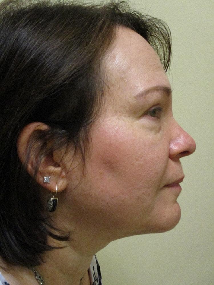 Arnold S. Breitbart, MD laser treatment after — Manhasset, NY