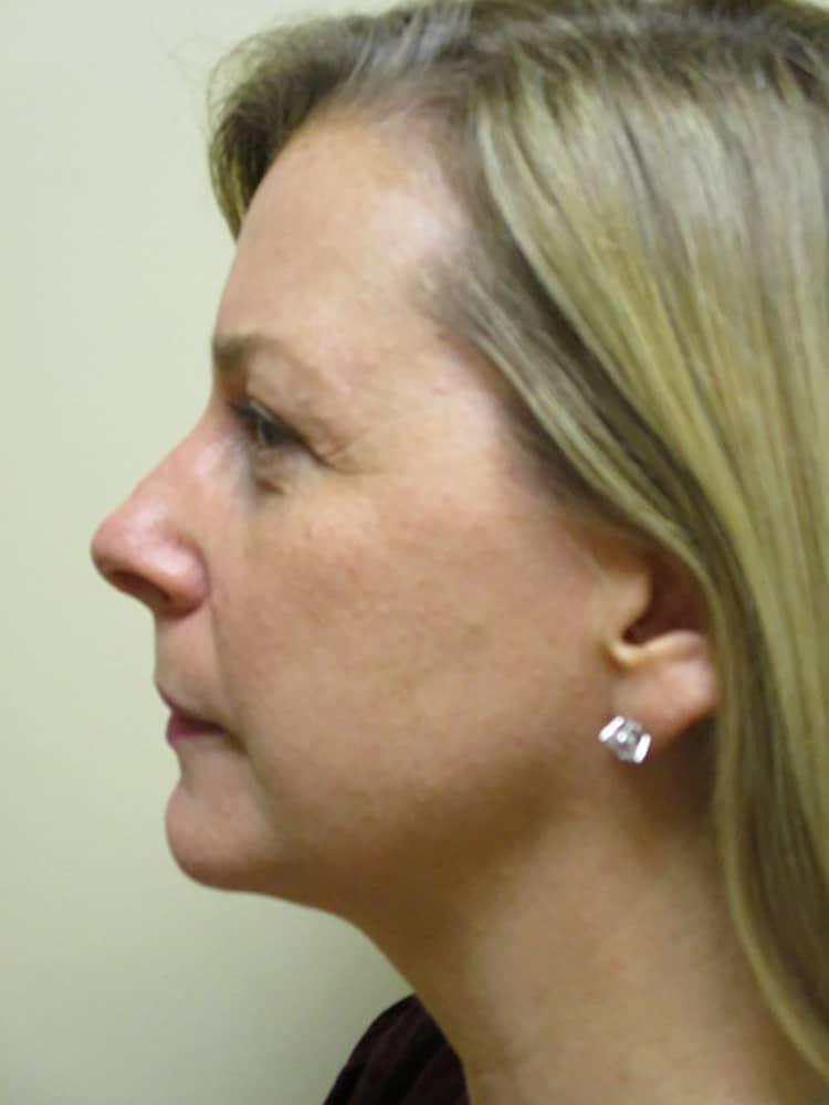 Arnold S. Breitbart, MD laser treatment after — Manhasset, NY