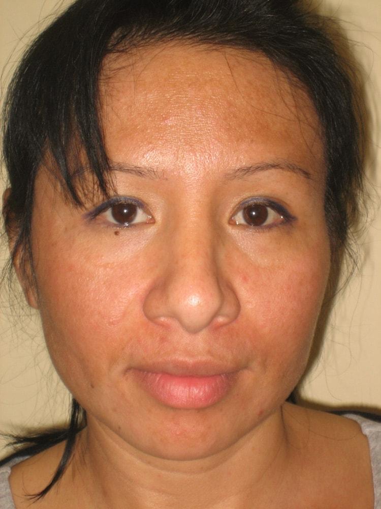 Arnold S. Breitbart, MD rhinoplasty after — Manhasset, NY