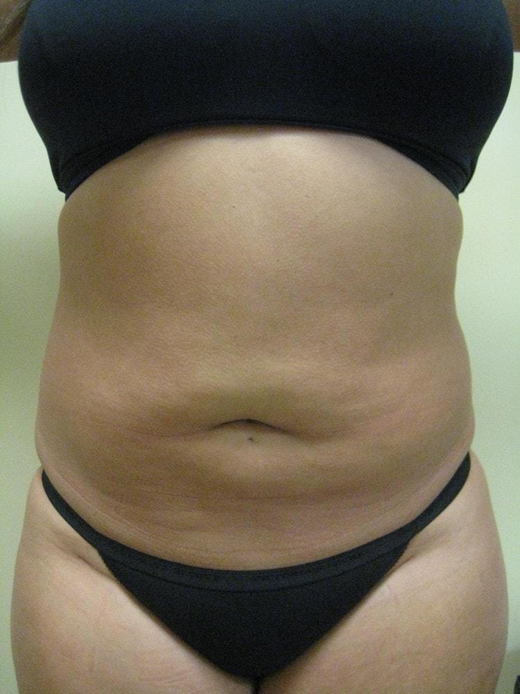 Arnold S. Breitbart, MD liposuction after — Manhasset, NY