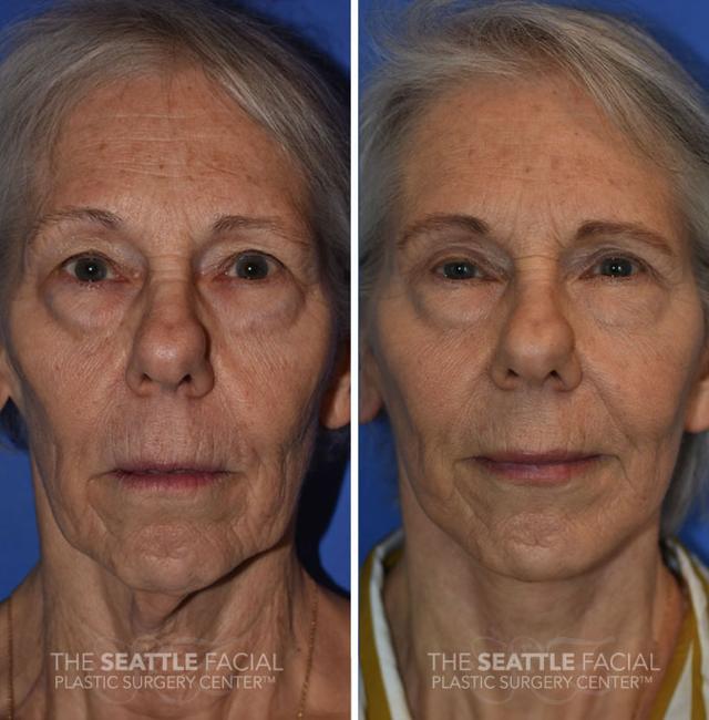 Facelift before at Dr William Portuese in Seattle, WA