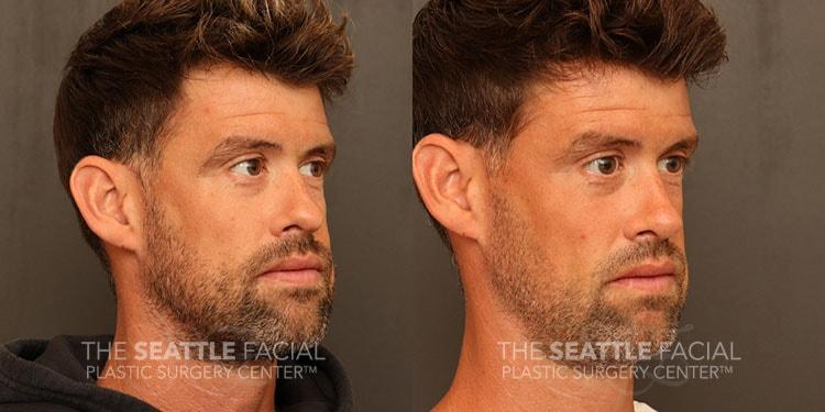 Dr William Portuese rhinoplasty result — Seattle, WA