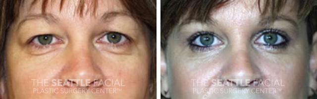 Blepharoplasty result at Dr William Portuese in Seattle, WA