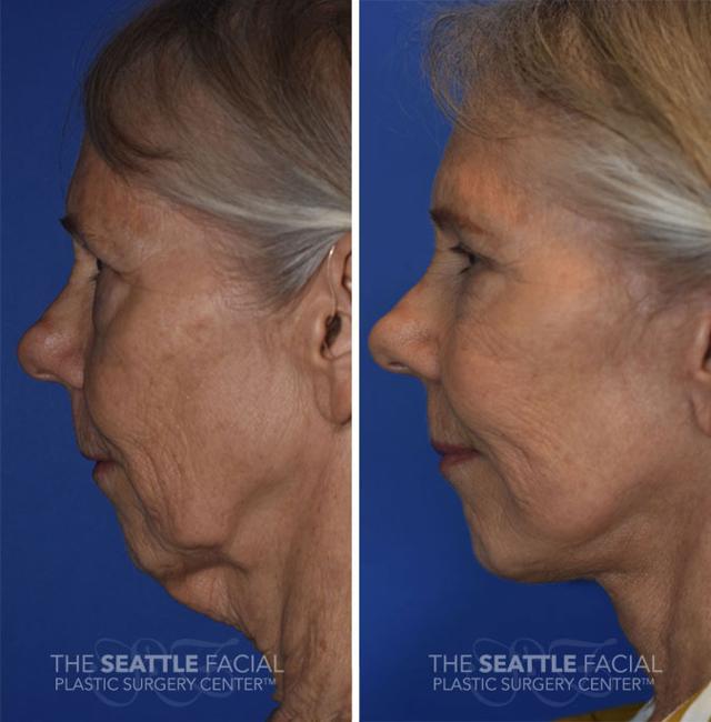 Facelift after at Dr William Portuese in Seattle, WA