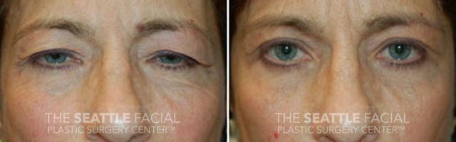 Blepharoplasty after at Dr William Portuese in Seattle, WA