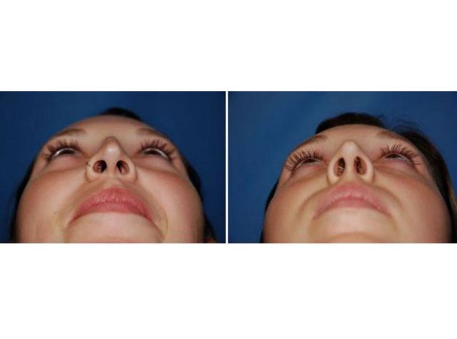 Rhinoplasty result at Dr William Portuese in Seattle, WA