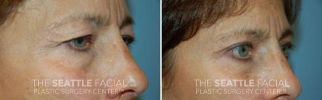 Blepharoplasty before at Dr William Portuese in Seattle, WA