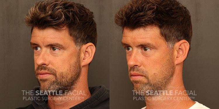 Dr William Portuese rhinoplasty result — Seattle, WA