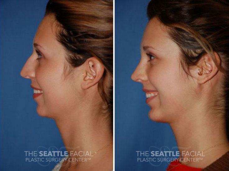 Dr William Portuese rhinoplasty result — Seattle, WA