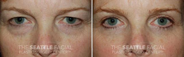 Blepharoplasty after at Dr William Portuese in Seattle, WA