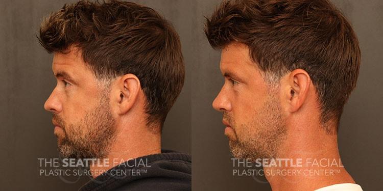 Dr William Portuese rhinoplasty result — Seattle, WA
