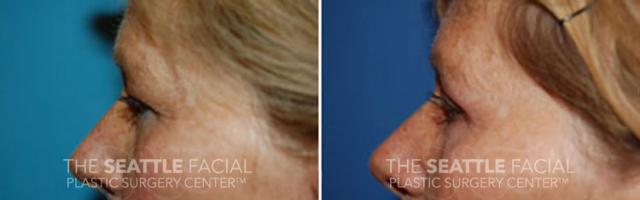 Blepharoplasty before at Dr William Portuese in Seattle, WA