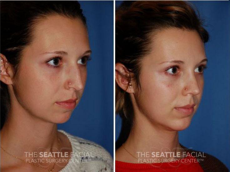 Dr William Portuese rhinoplasty result — Seattle, WA
