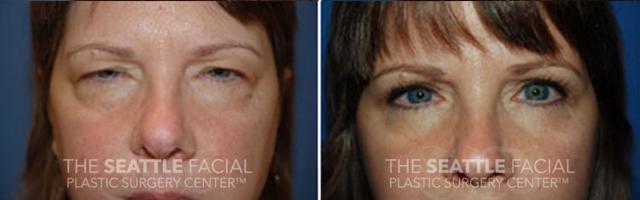 Blepharoplasty after at Dr William Portuese in Seattle, WA