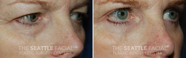Blepharoplasty before at Dr William Portuese in Seattle, WA