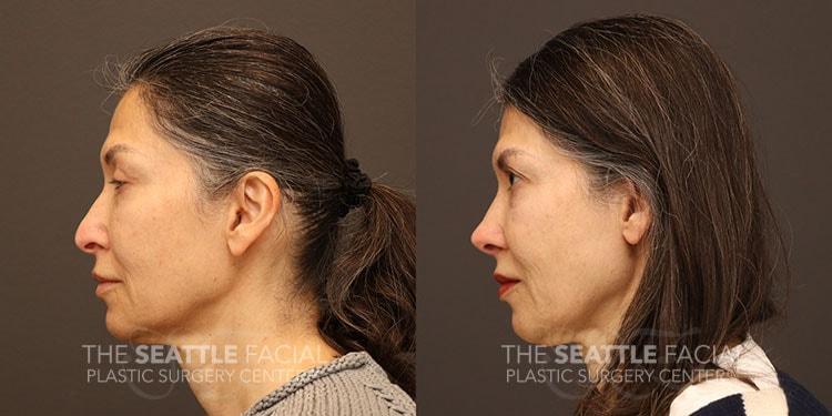 Dr William Portuese rhinoplasty result — Seattle, WA