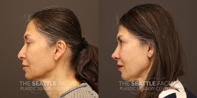 Functional Rhinoplasty result at Dr William Portuese in Seattle, WA