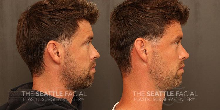 Dr William Portuese rhinoplasty result — Seattle, WA
