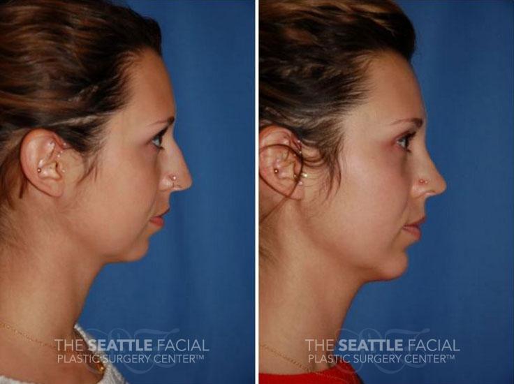 Dr William Portuese rhinoplasty result — Seattle, WA