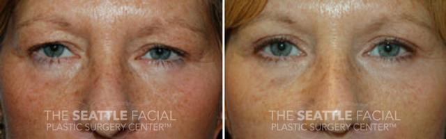 Blepharoplasty after at Dr William Portuese in Seattle, WA