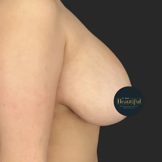 Breast Lift before at Be That Beautiful in Beverly Hills, CA