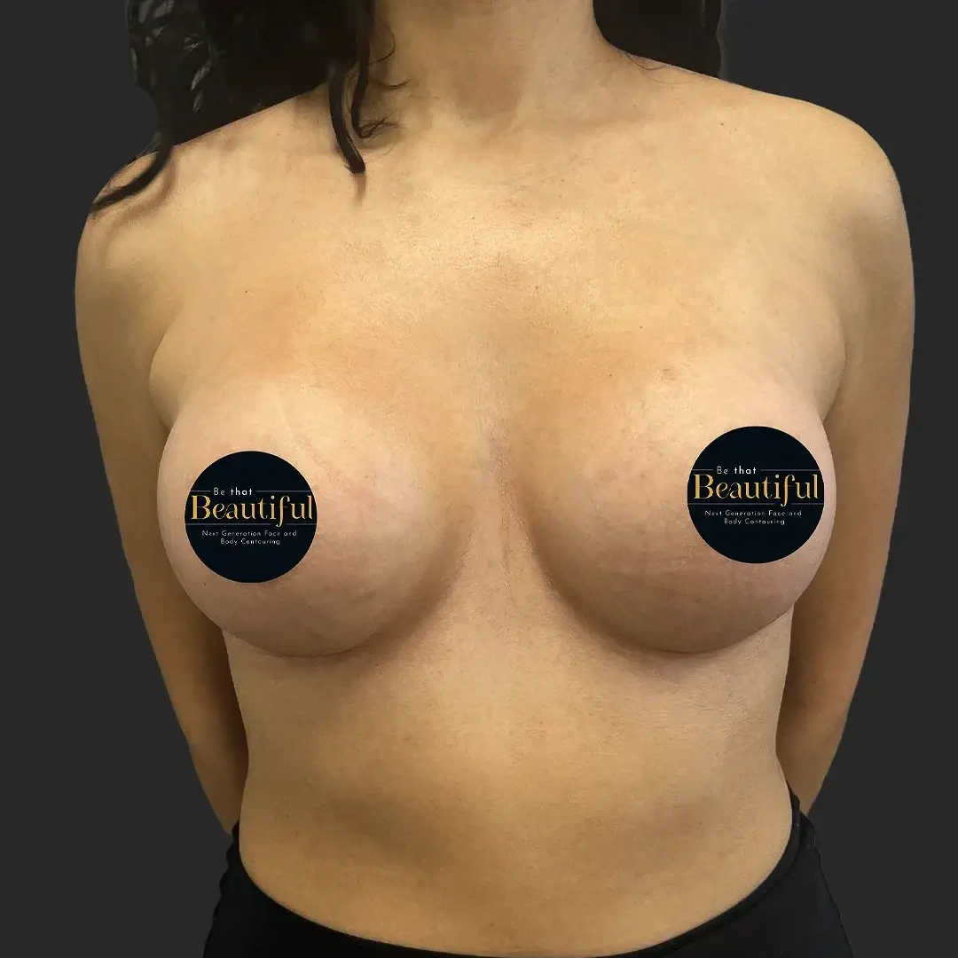 Be That Beautiful breast augmentation after — Beverly Hills, CA
