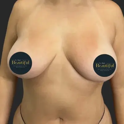 Be That Beautiful breast lift after — Beverly Hills, CA