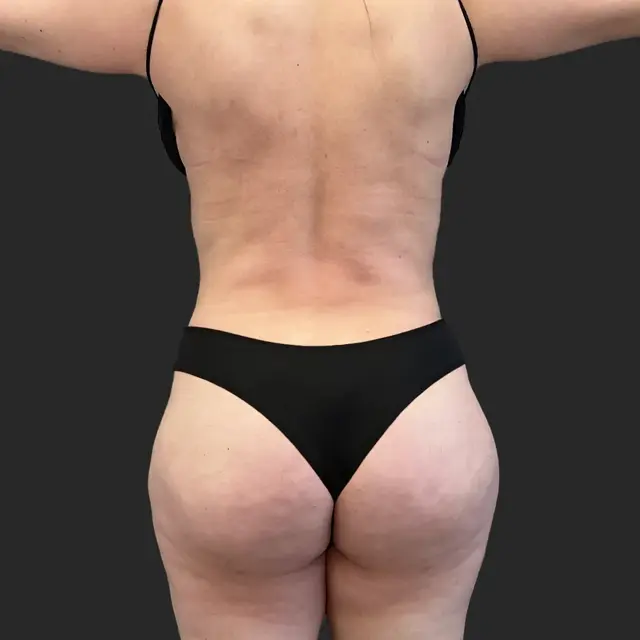 Brazilian Butt Lift before at Be That Beautiful in Beverly Hills, CA