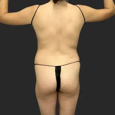 Tummy Tuck before at Be That Beautiful in Beverly Hills, CA