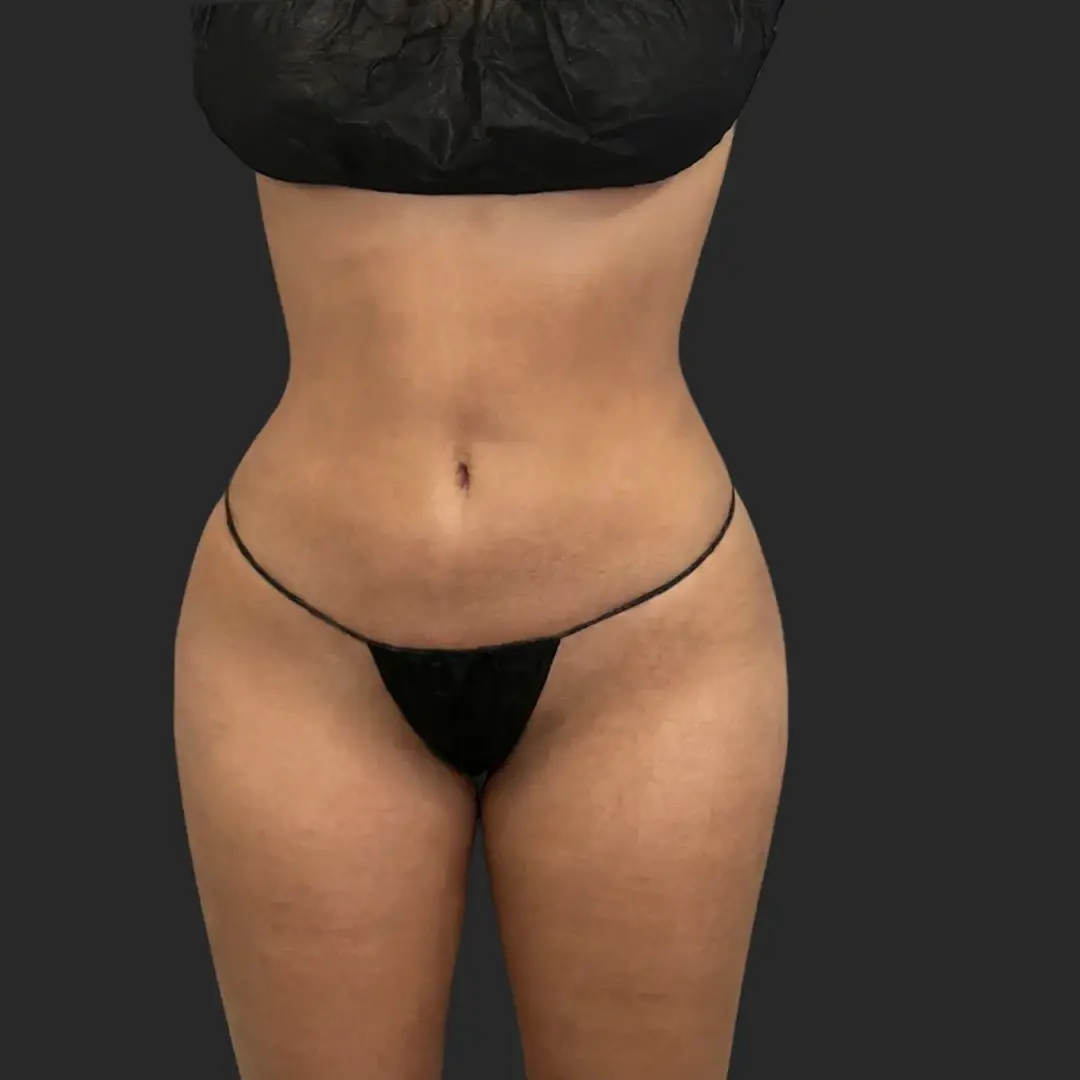Be That Beautiful body contouring after — Beverly Hills, CA