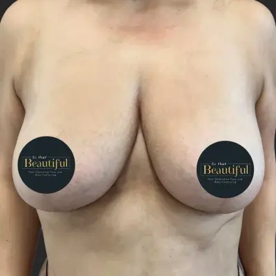 Breast Lift after at Be That Beautiful in Beverly Hills, CA