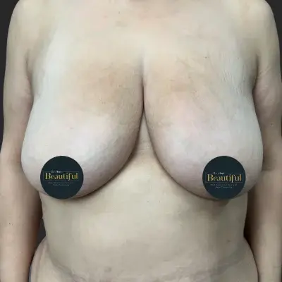 Breast Lift before at Be That Beautiful in Beverly Hills, CA
