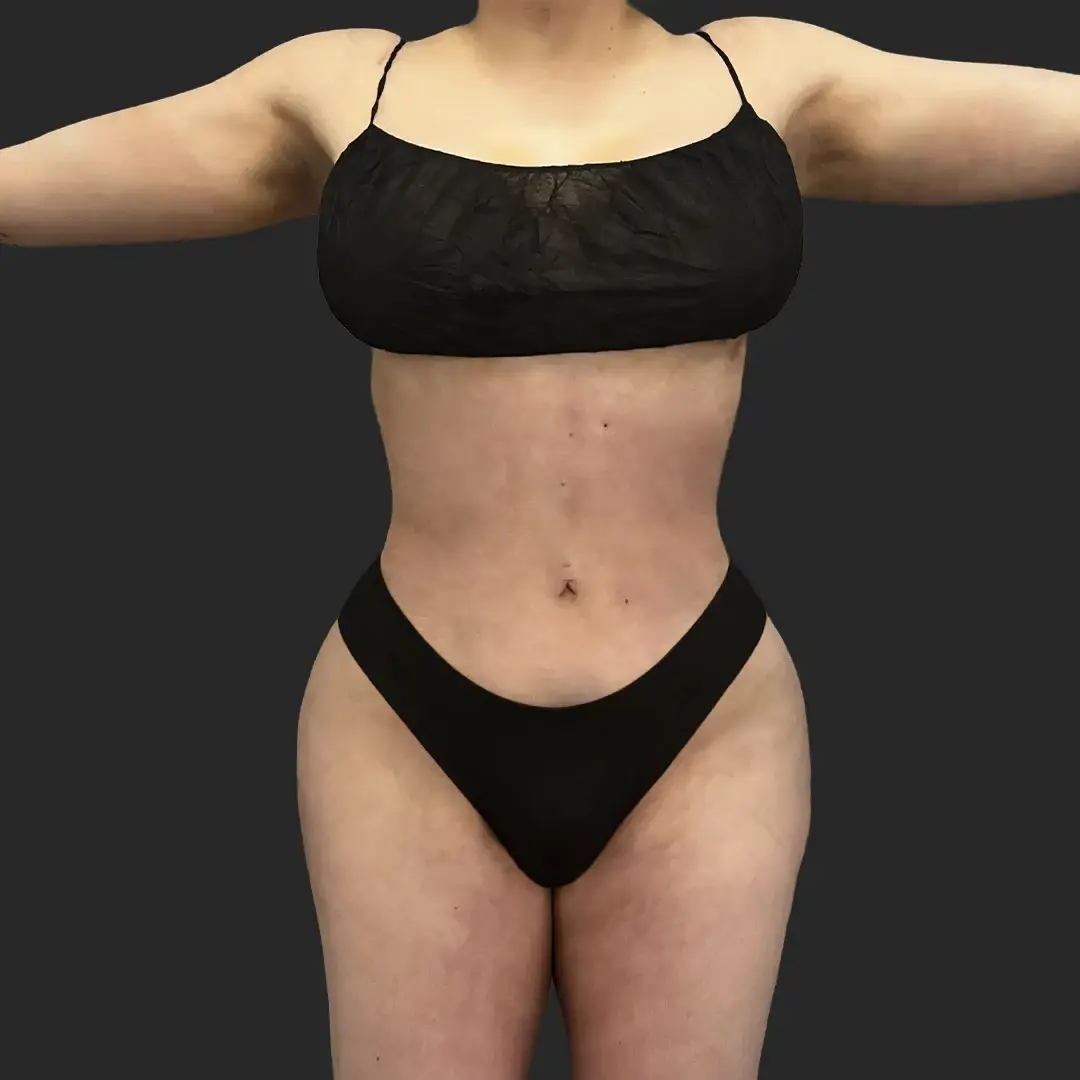 Be That Beautiful body contouring after — Beverly Hills, CA
