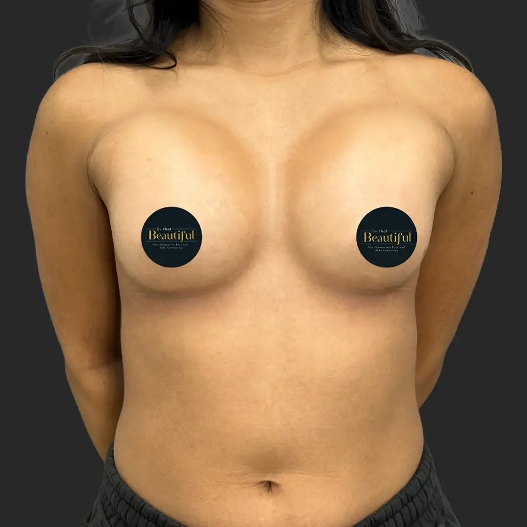 Be That Beautiful breast augmentation after — Beverly Hills, CA