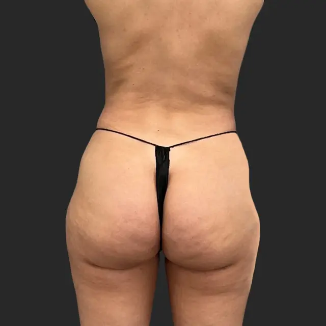 Brazilian Butt Lift before at Be That Beautiful in Beverly Hills, CA