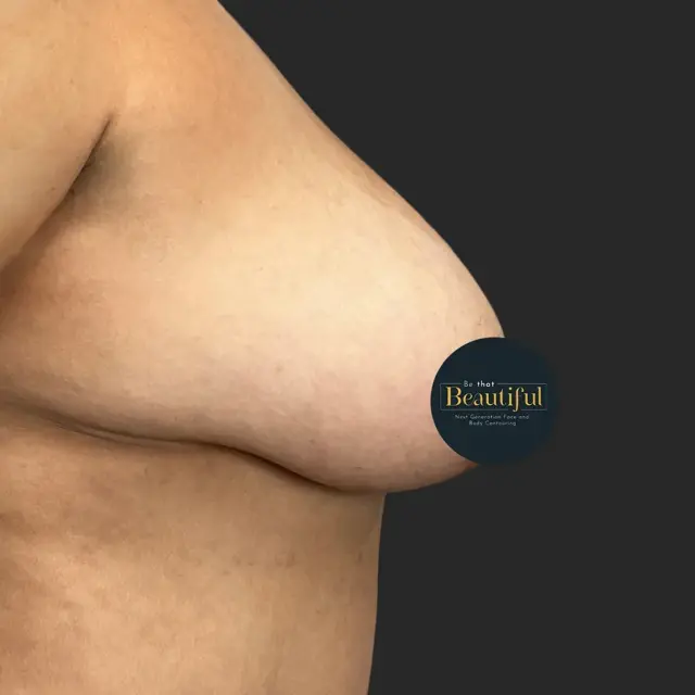 Breast Lift before at Be That Beautiful in Beverly Hills, CA