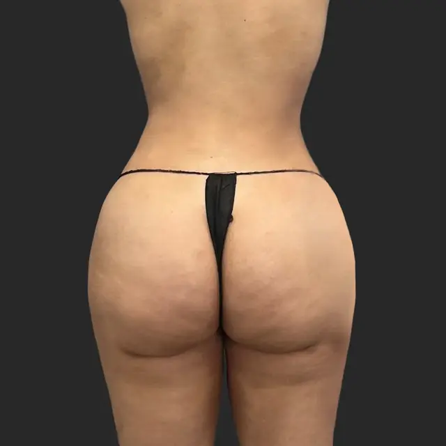 Brazilian Butt Lift after at Be That Beautiful in Beverly Hills, CA