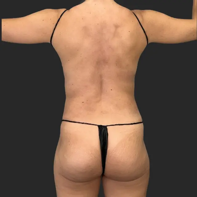 Thigh Lift before at Be That Beautiful in Beverly Hills, CA