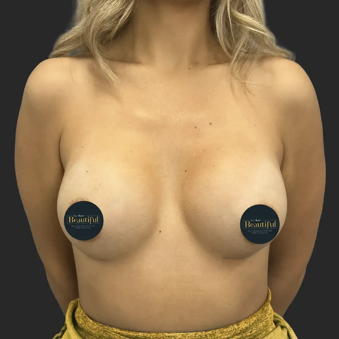 Be That Beautiful breast augmentation after — Beverly Hills, CA